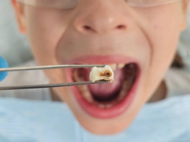 Best Emergency Dentist for Lost Fillings or Crowns in Elk Point, SD